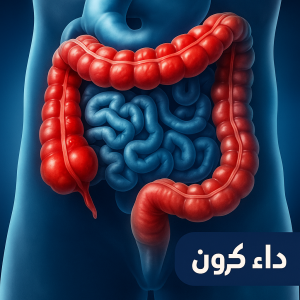 ما هو مرض كرون؟