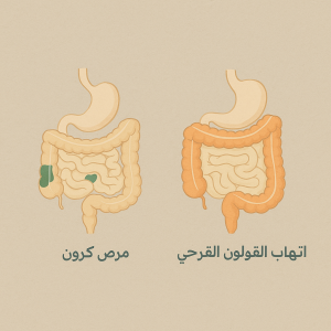 ما الفرق بين مرض كرون والتهاب القولون التقرحي؟