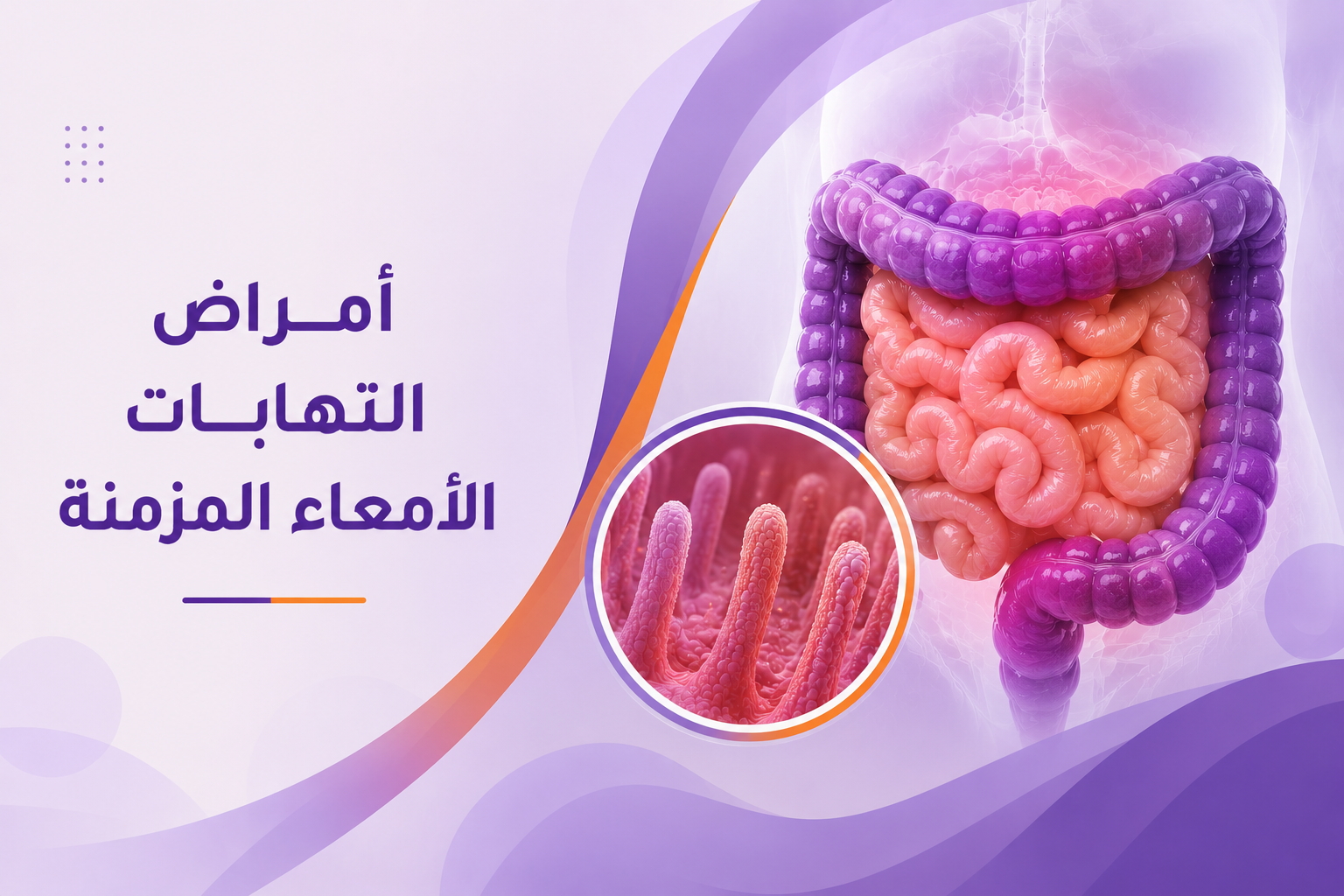 أمراض التهابات الأمعاء المزمنة